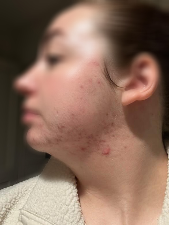 After chemical peel at Kovara