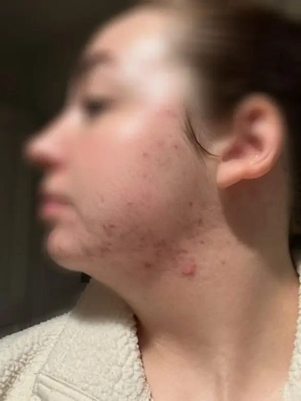 After chemical peel at Kovara