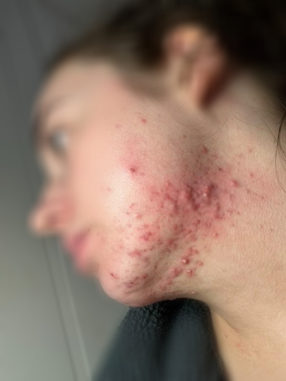 Before chemical peel at Kovara