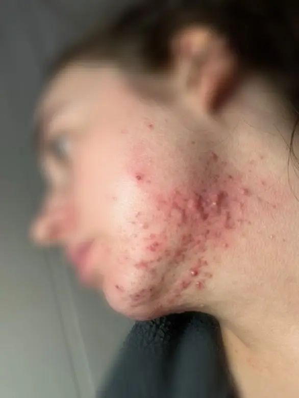 Before chemical peel at Kovara