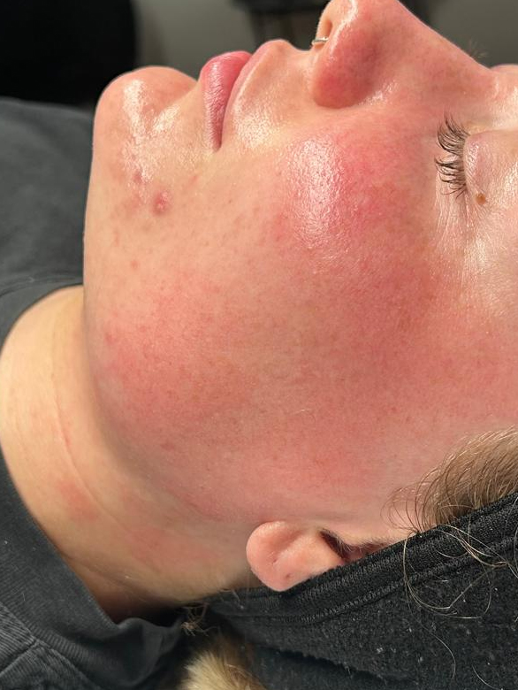After dermaplaning at Kovara